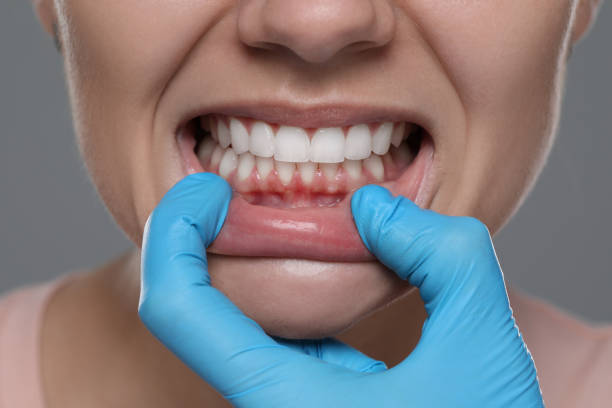 How Gum Disease Can Affect Your Smile