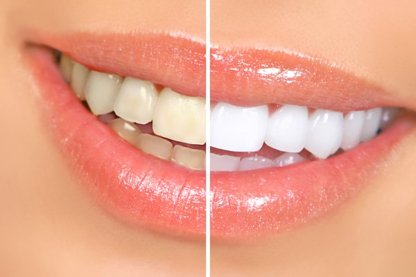 4 Things To Know About Kor Whitening Treatments