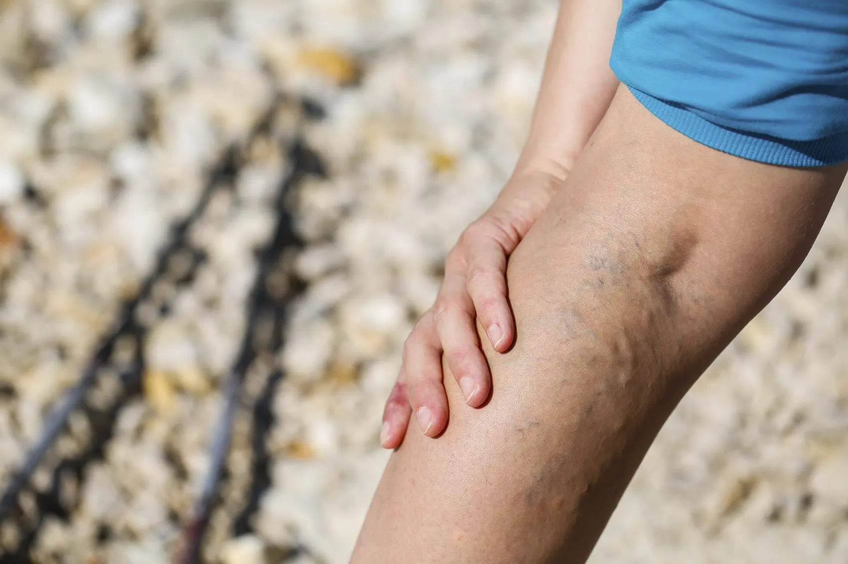 How Varicose Veins Can Affect Your Daily Activities