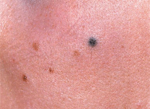 Recognizing Early Signs of Skin Cancer