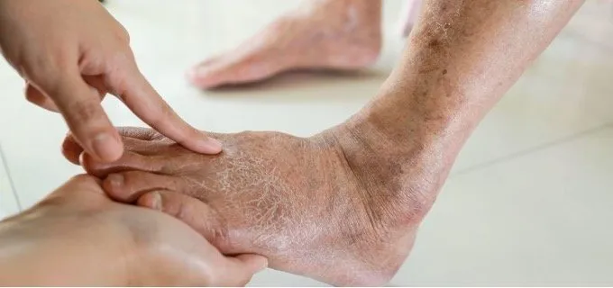 Symptoms and Solutions of Chronic Venous Insufficiency
