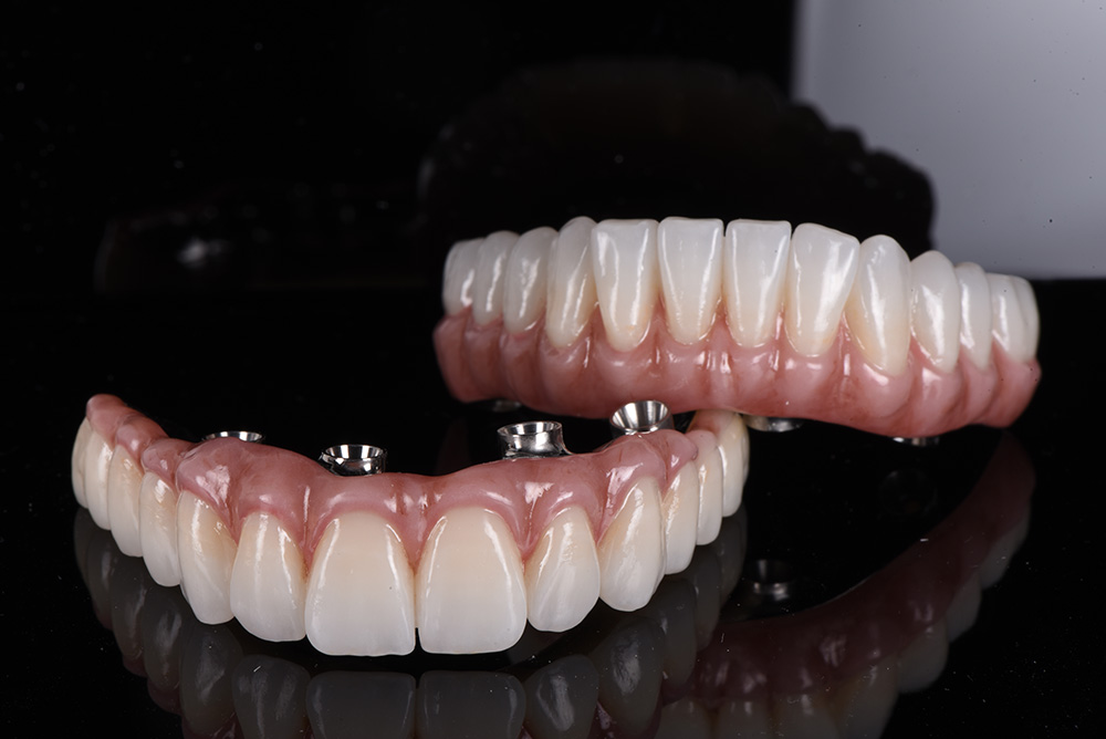 The Advantages of Endodontic Implants Over Other Options