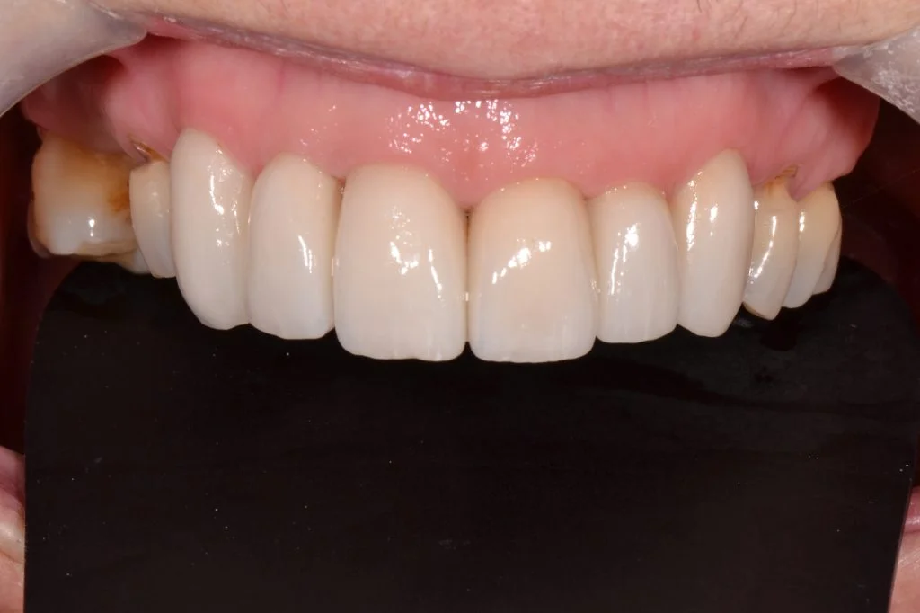 The Advantages of Porcelain Crowns for Natural-Looking Restoration