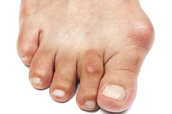 Understanding the Causes and Treatments for Bunions
