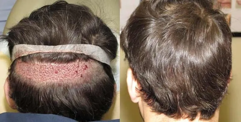 Evaluating the Success Rates of Different Hair Transplant Methods