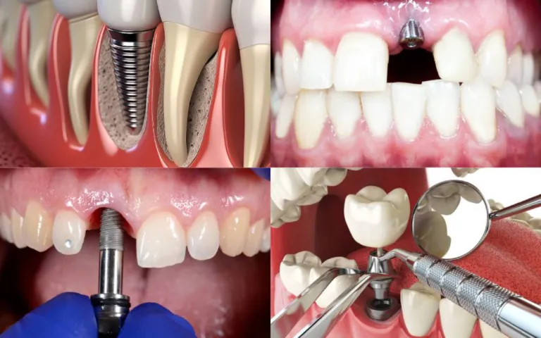 Four Tips for Maintaining Your Dental Implants