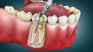 The Long-Term Benefits of Root Canal Treatment The Long-Term Benefits of Root Canal Treatment