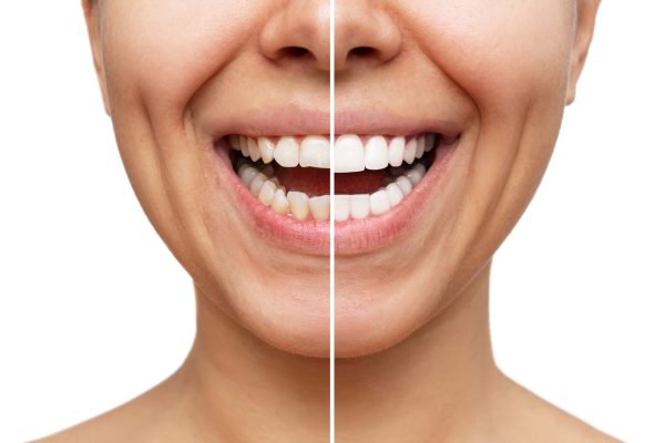 Understanding The Process of Veneers Procedures Understanding The Process of Veneers Procedures