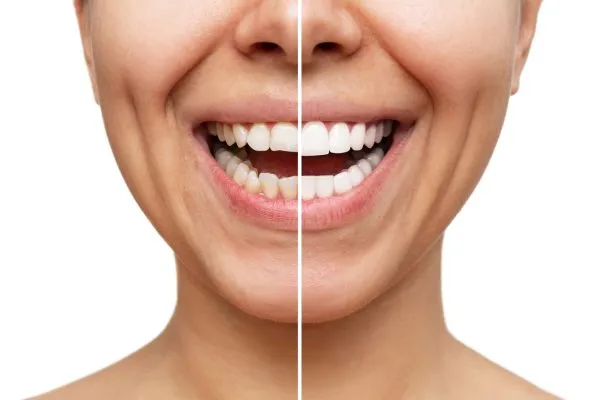 Understanding The Process of Veneers Procedures