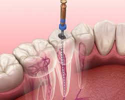 What To Know About Root Canal Procedures What To Know About Root Canal Procedures