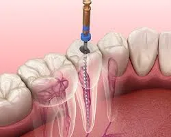 What To Know About Root Canal Procedures