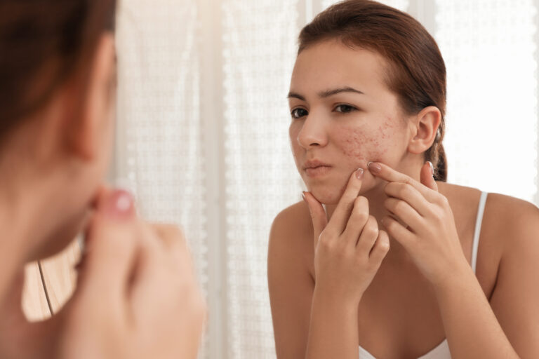 Exploring Common Dermatology Treatments for Acne