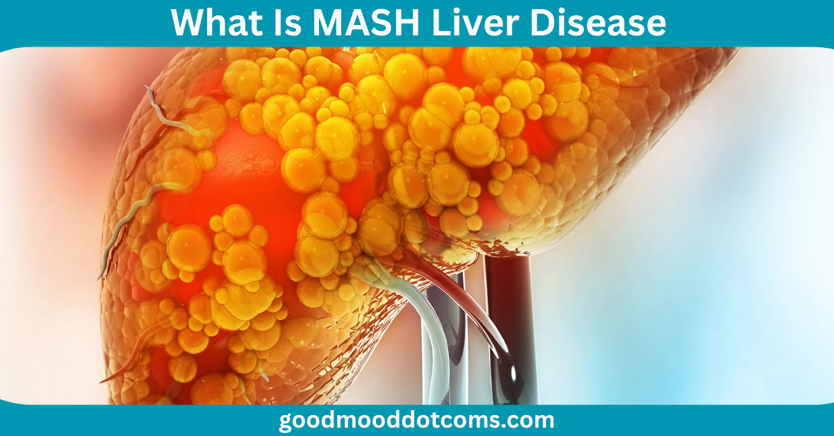 What Is MASH Liver Disease What Is MASH Liver Disease
