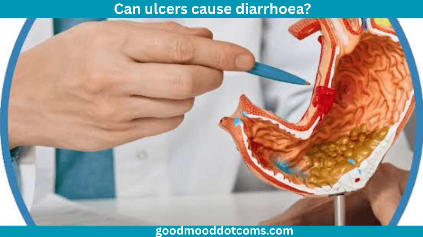 Can Ulcers Cause Diarrhea? Can Ulcers Cause Diarrhea?